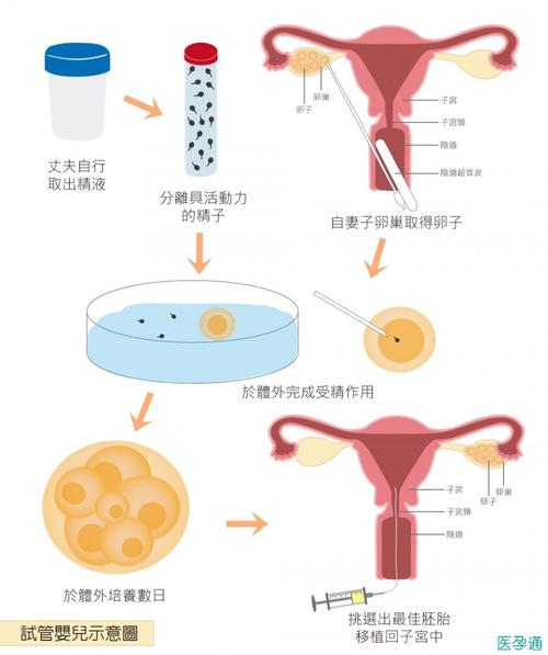 供卵试管的步骤和流程_供卵试管：全面解读步骤和流程